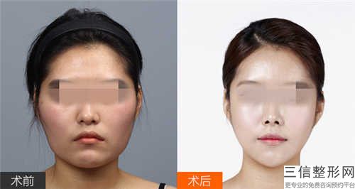 河南省好的反頜糾正機構推薦：反頜糾正醫院前30請知曉