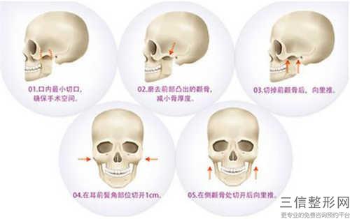 什么樣的人需要實施下頜角截骨整形術