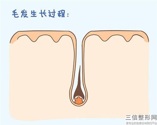 opt激光脫毛后整個(gè)身體毛囊會(huì)造成阻塞嗎