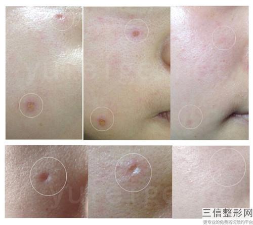 手術(shù)去色素痣術(shù)后護(hù)理工作