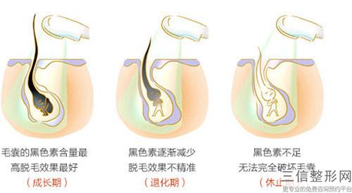 脈沖光脫毛的危害和后遺癥是什么  